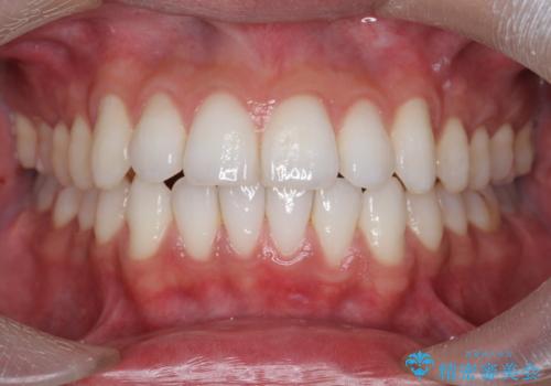 突出した前歯を改善! マウスピース治療の症例 治療後