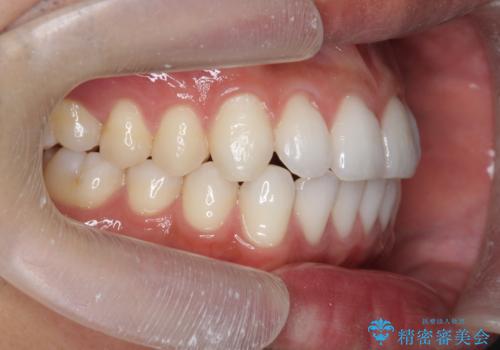 突出した前歯を改善! マウスピース治療の治療後