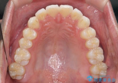 突出した前歯を改善! マウスピース治療の治療後