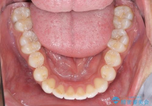 突出した前歯を改善! マウスピース治療の治療後