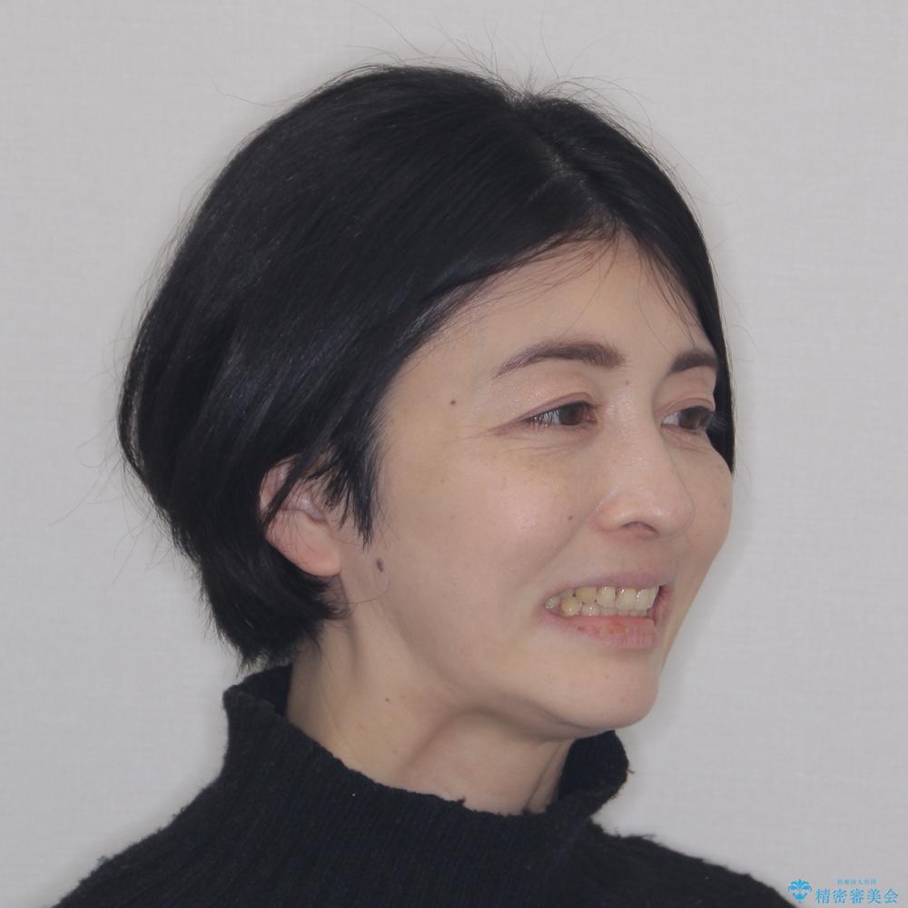 【モニター】飛び出た前歯を整えたい ワイヤー矯正治療の治療後(顔貌)