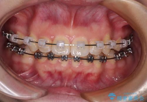 口が閉じられない ワイヤー装置での抜歯矯正の治療中