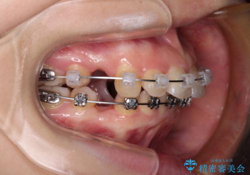 口が閉じられない　ワイヤー装置での抜歯矯正の治療中