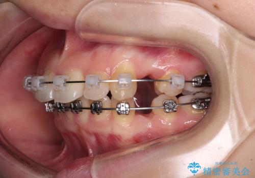 口が閉じられない ワイヤー装置での抜歯矯正の治療中