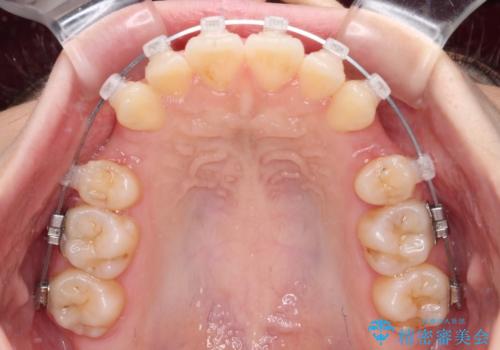 口が閉じられない ワイヤー装置での抜歯矯正の治療中