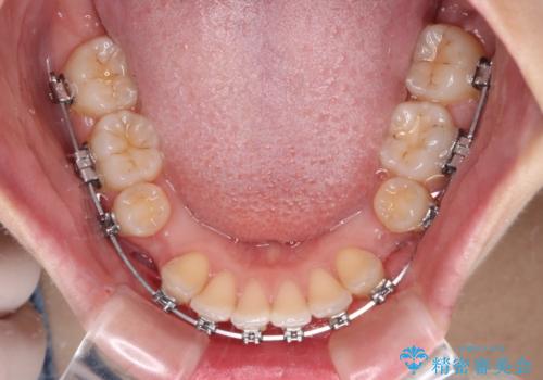 口が閉じられない ワイヤー装置での抜歯矯正の治療中