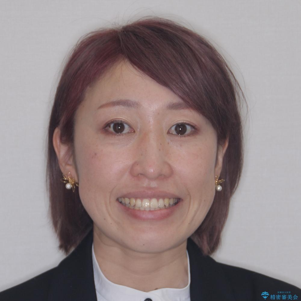 【モニター】カリエール・ディスタライザーを併用した八重歯のインビザライン矯正 の治療後(顔貌)