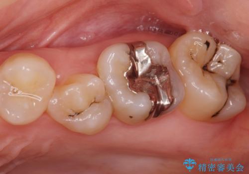 黒くなった奥歯をジルコニアクラウンにの症例 治療前