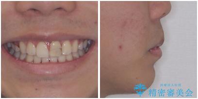 膨らんだ口元 ワイヤー装置での抜歯矯正の治療後(顔貌)