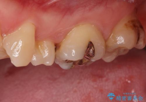 黒くなった奥歯をジルコニアクラウンにの治療前