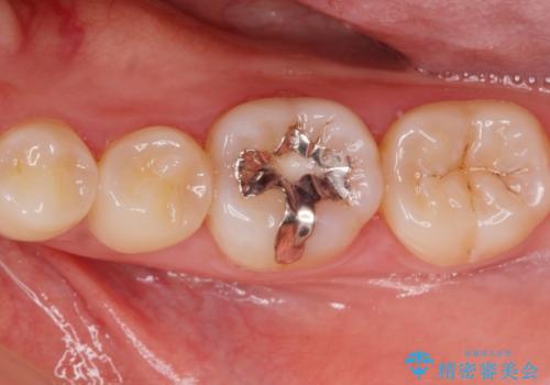 銀の詰め物を白くしたい。の症例 治療前