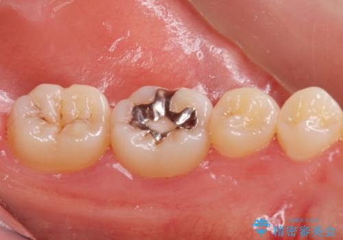 銀の詰め物を白くしたい。の治療前