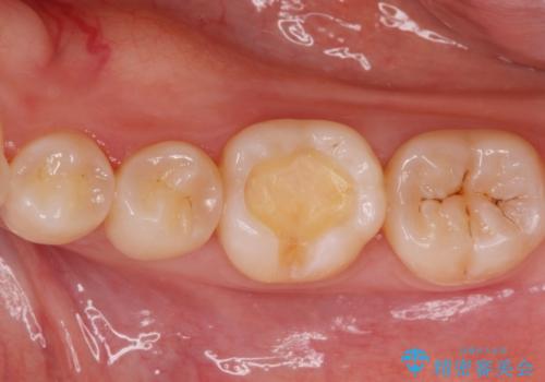 銀の詰め物を白くしたい。の治療中