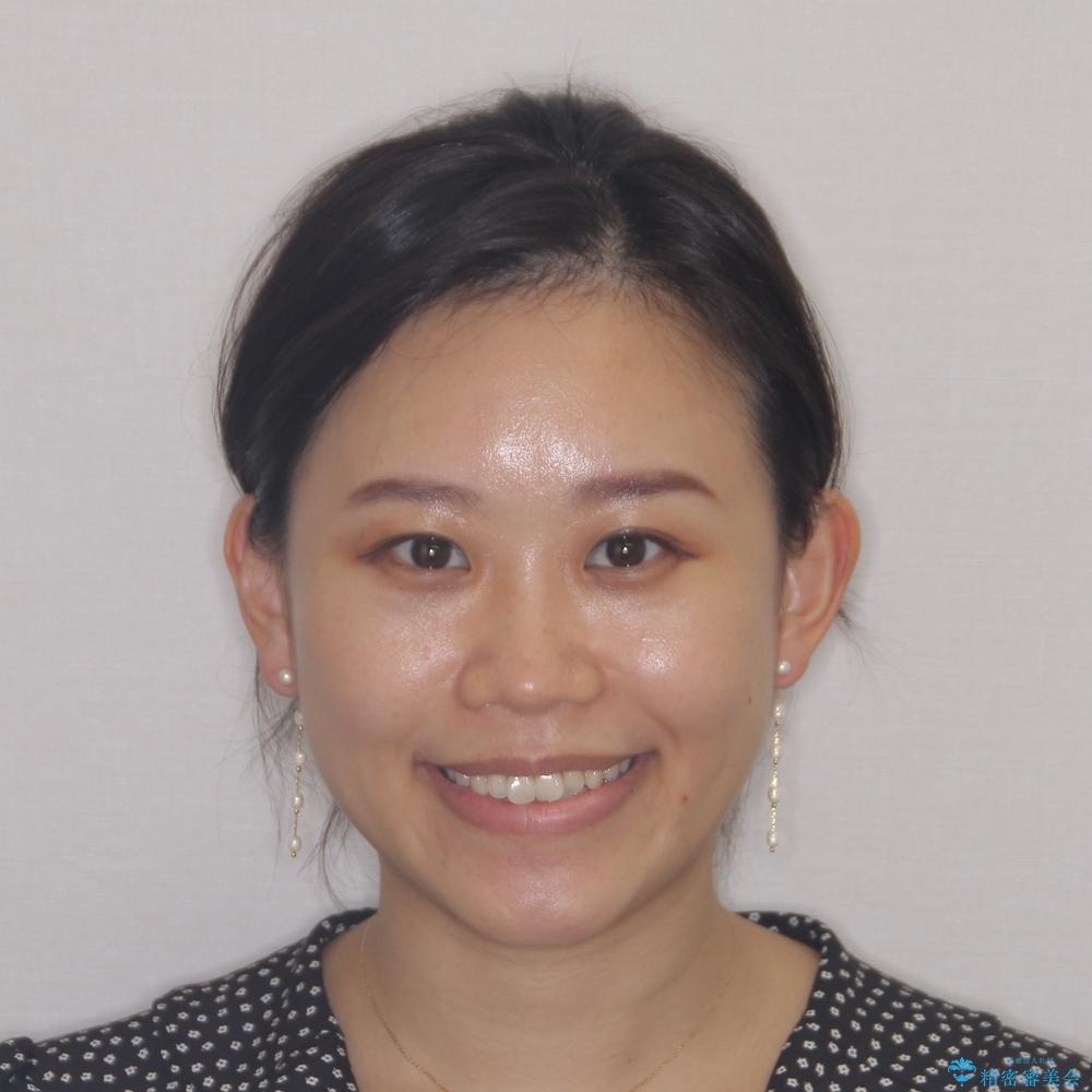 【モニター】前歯のデコボコをインビザラインで改善の治療前(顔貌)