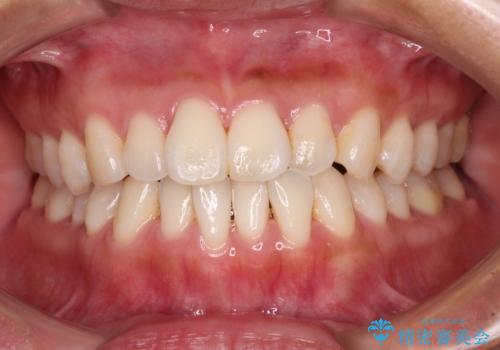 【モニター】前歯のデコボコをインビザラインで改善の症例 治療前