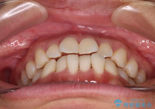 【モニター】前歯のデコボコをインビザラインで改善の治療前