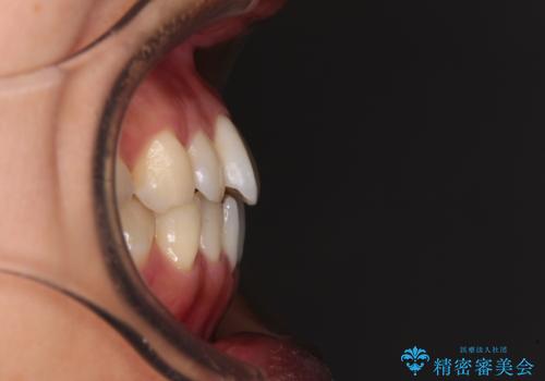 【モニター】前歯のデコボコをインビザラインで改善の治療前