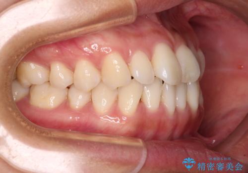 【モニター】前歯のデコボコをインビザラインで改善の治療前