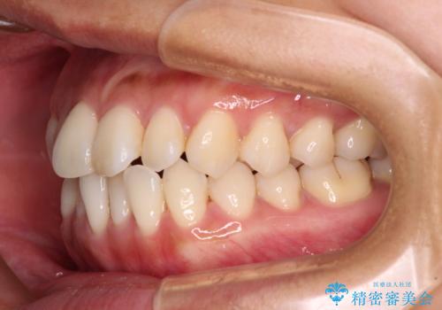 【モニター】前歯のデコボコをインビザラインで改善の治療前