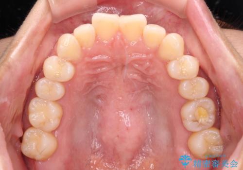 【モニター】前歯のデコボコをインビザラインで改善の治療前