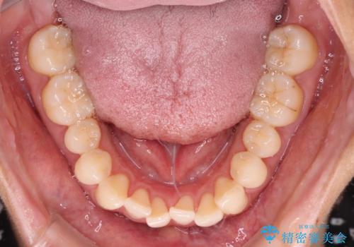 【モニター】前歯のデコボコをインビザラインで改善の治療前