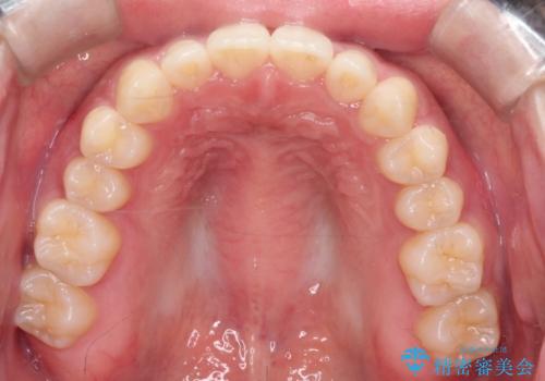 驚くほどの変化!　マウスピース矯正で前歯のすきっ歯を効果的に改善しましたの治療後