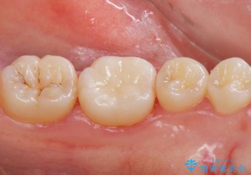 銀の詰め物を白くしたい。の治療後