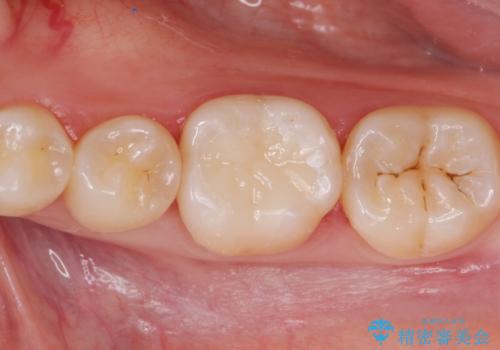 銀の詰め物を白くしたい。の症例 治療後