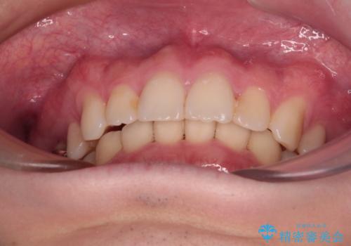 インビザラインによる矯正治療と奥歯のインプラント治療の治療後