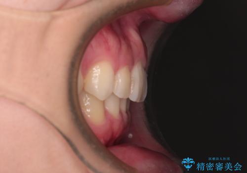 インビザラインによる矯正治療と奥歯のインプラント治療の治療後