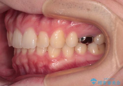 インビザラインによる矯正治療と奥歯のインプラント治療の治療後