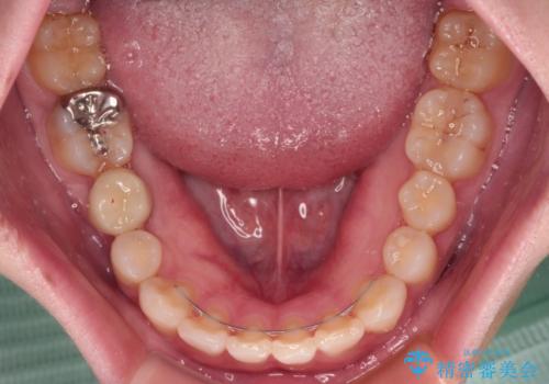 インビザラインによる矯正治療と奥歯のインプラント治療の治療後