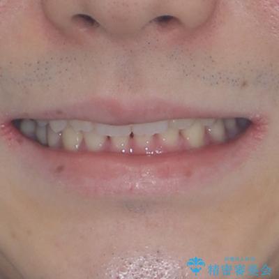 インビザラインによる矯正治療と奥歯のインプラント治療の治療後（顔貌）