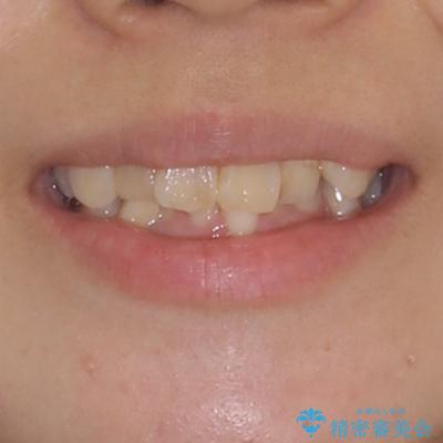 デコボコと深い咬み合わせ　ワイヤー装置での抜歯矯正の治療前（顔貌）