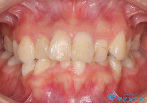 デコボコと深い咬み合わせ ワイヤー装置での抜歯矯正の症例 治療前