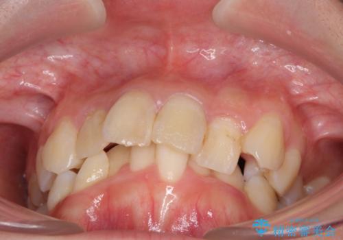 デコボコと深い咬み合わせ ワイヤー装置での抜歯矯正の治療前