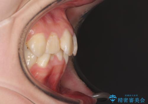 デコボコと深い咬み合わせ ワイヤー装置での抜歯矯正の治療前