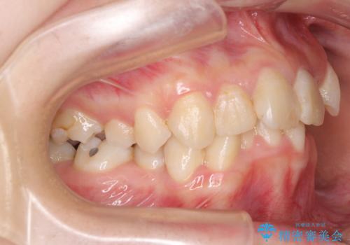 デコボコと深い咬み合わせ　ワイヤー装置での抜歯矯正の治療前
