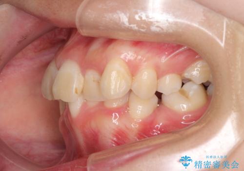 デコボコと深い咬み合わせ ワイヤー装置での抜歯矯正の治療前