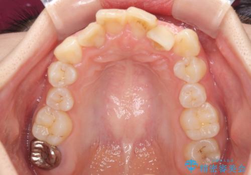 デコボコと深い咬み合わせ ワイヤー装置での抜歯矯正の治療前