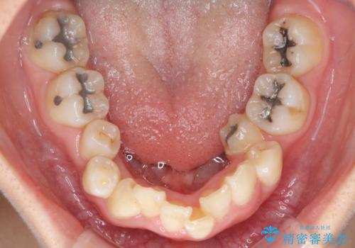 デコボコと深い咬み合わせ ワイヤー装置での抜歯矯正の治療前
