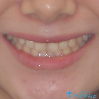 治療途中の奥歯と矯正治療の後戻り　インビザライン・ライトによる矯正治療の治療前（顔貌）