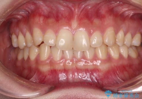 治療途中の奥歯と矯正治療の後戻り インビザライン・ライトによる矯正治療の症例 治療前