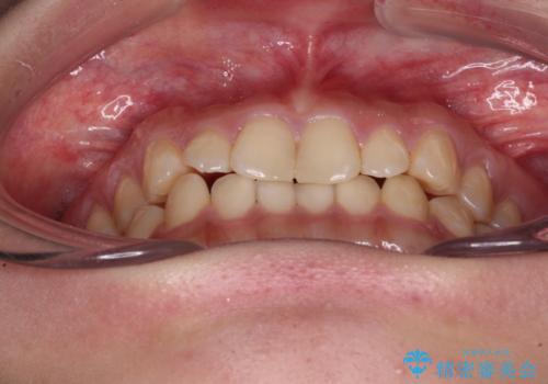 治療途中の奥歯と矯正治療の後戻り　インビザライン・ライトによる矯正治療の治療前