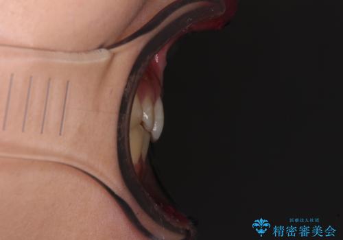 治療途中の奥歯と矯正治療の後戻り インビザライン・ライトによる矯正治療の治療前