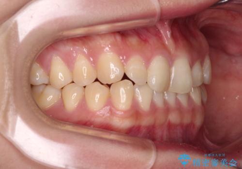 治療途中の奥歯と矯正治療の後戻り インビザライン・ライトによる矯正治療の治療前