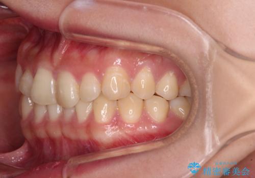 治療途中の奥歯と矯正治療の後戻り インビザライン・ライトによる矯正治療の治療前