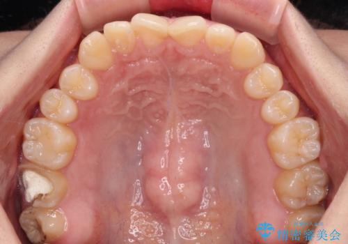 治療途中の奥歯と矯正治療の後戻り インビザライン・ライトによる矯正治療の治療前