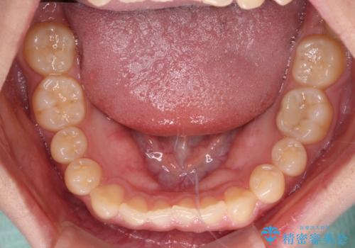 治療途中の奥歯と矯正治療の後戻り インビザライン・ライトによる矯正治療の治療前