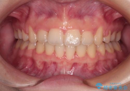 口が閉じられない　ワイヤー装置での抜歯矯正の症例 治療後